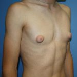 Gynecomastia Before & After Patient #5593