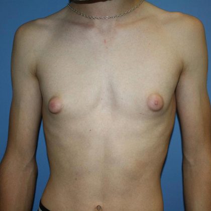 Gynecomastia Before & After Patient #5593