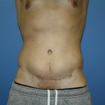 Circumferential Tummy Tuck Before & After Patient #5594
