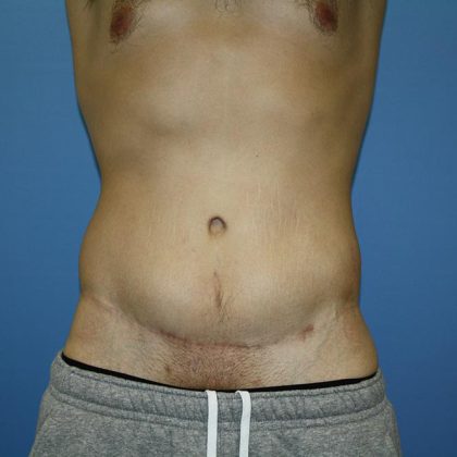 Circumferential Tummy Tuck Before & After Patient #5594