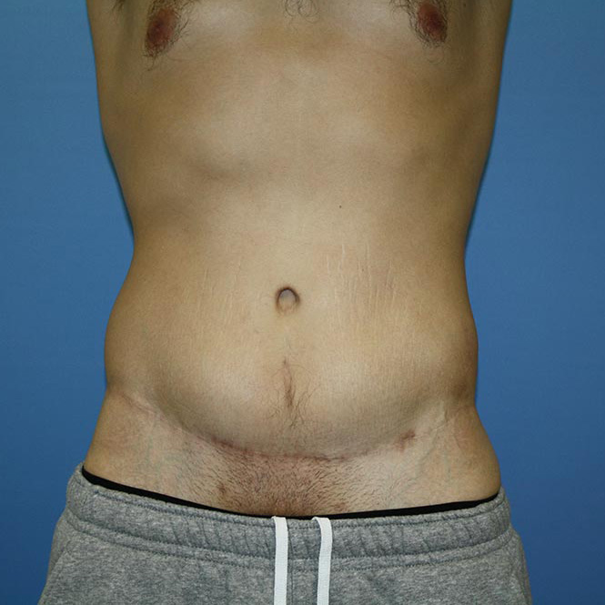 Circumferential Tummy Tuck Before & After Patient #5594