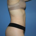 Tummy Tuck Before & After Patient #5595