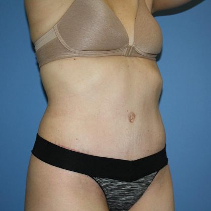 Tummy Tuck Before & After Patient #5595