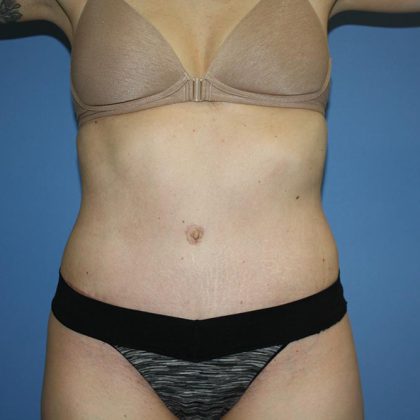 Tummy Tuck Before & After Patient #5595