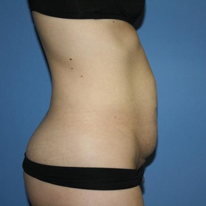 Tummy Tuck Before & After Patient #5595