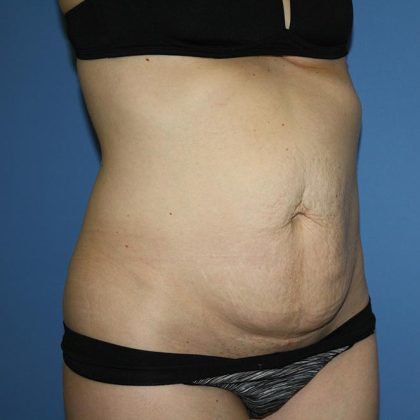 Tummy Tuck Before & After Patient #5595