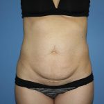 Tummy Tuck Before & After Patient #5595