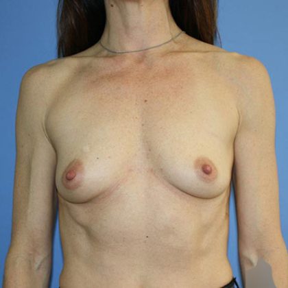 Breast Augmentation Before & After Patient #5598