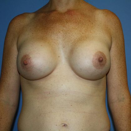 Breast Augmentation Before & After Patient #5615