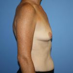 Breast Augmentation Before & After Patient #5615