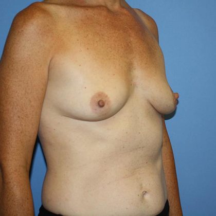 Breast Augmentation Before & After Patient #5615
