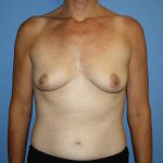 Breast Augmentation Before & After Patient #5615