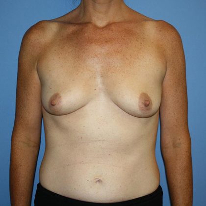 Breast Augmentation Before & After Patient #5615