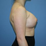 Breast Augmentation Before & After Patient #5626