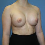 Breast Augmentation Before & After Patient #5626