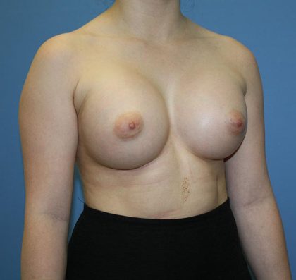 Breast Augmentation Before & After Patient #5626