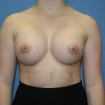 Breast Augmentation Before & After Patient #5626