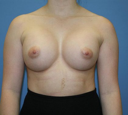 Breast Augmentation Before & After Patient #5626