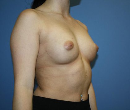 Breast Augmentation Before & After Patient #5626