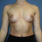 Breast Augmentation Before & After Patient #5626