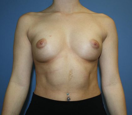 Breast Augmentation Before & After Patient #5626