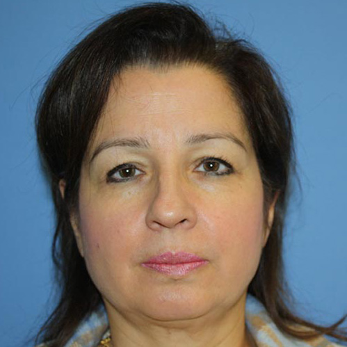 Nose Surgery Before & After Patient #5639