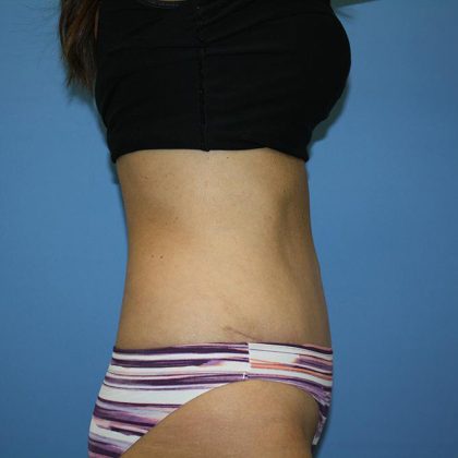 Tummy Tuck Before & After Patient #5641