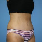 Tummy Tuck Before & After Patient #5641