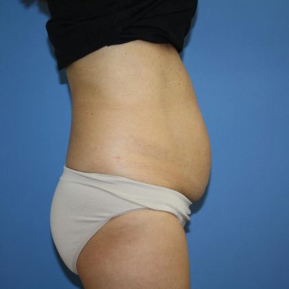 Tummy Tuck Before & After Patient #5641