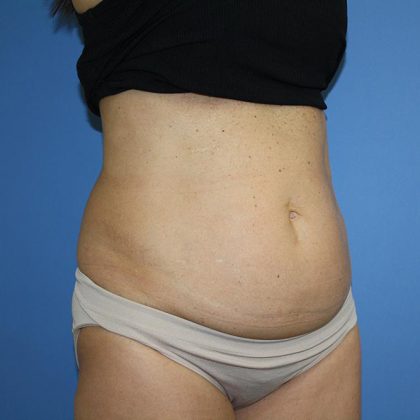 Tummy Tuck Before & After Patient #5641