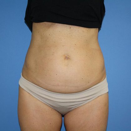 Tummy Tuck Before & After Patient #5641