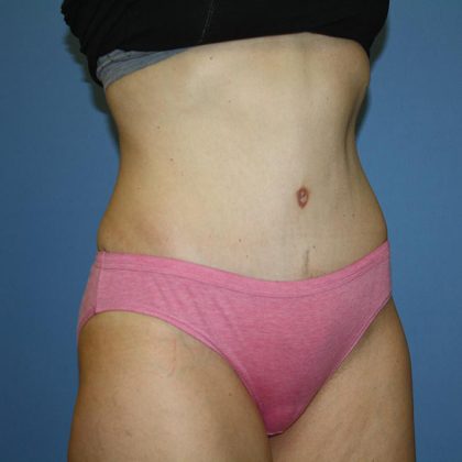 Tummy Tuck Before & After Patient #5660