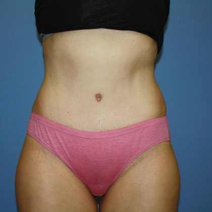 Tummy Tuck Before & After Patient #5660