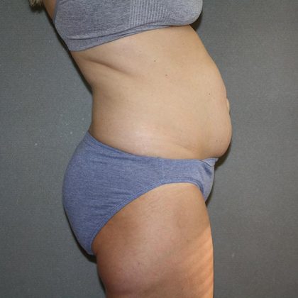 Tummy Tuck Before & After Patient #5660