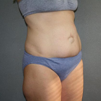 Tummy Tuck Before & After Patient #5660