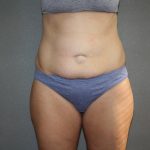 Tummy Tuck Before & After Patient #5660