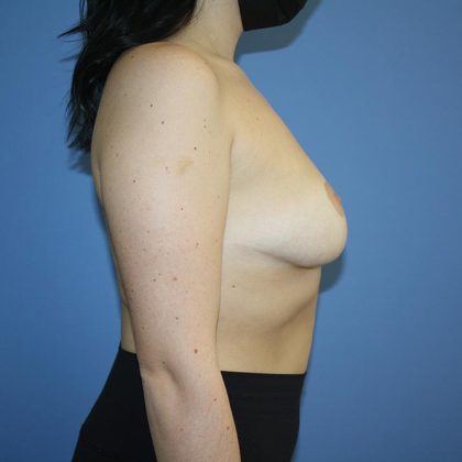 Breast Reduction Before & After Patient #5675