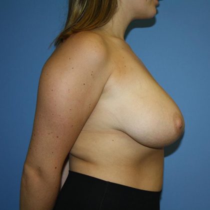 Breast Reduction Before & After Patient #5675