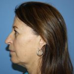 Nose Surgery Before & After Patient #5682