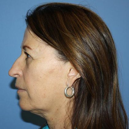 Nose Surgery Before & After Patient #5682