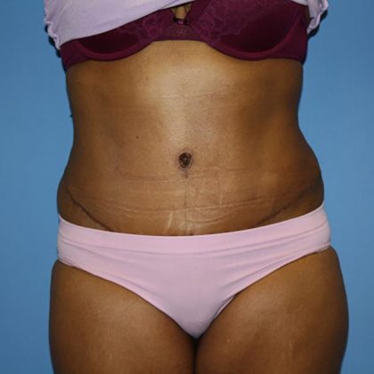 Tummy Tuck Before & After Patient #5693