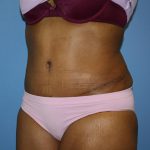 Tummy Tuck Before & After Patient #5693