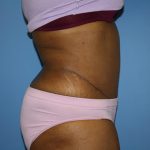 Tummy Tuck Before & After Patient #5693