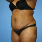 Tummy Tuck Before & After Patient #5693