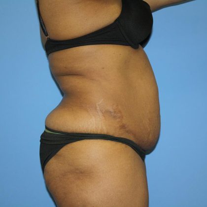 Tummy Tuck Before & After Patient #5693