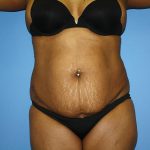 Tummy Tuck Before & After Patient #5693