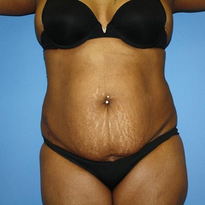 Tummy Tuck Before & After Patient #5693