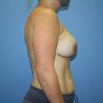 Breast Reconstruction Before & After Patient #5694