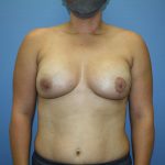 Breast Reconstruction Before & After Patient #5694