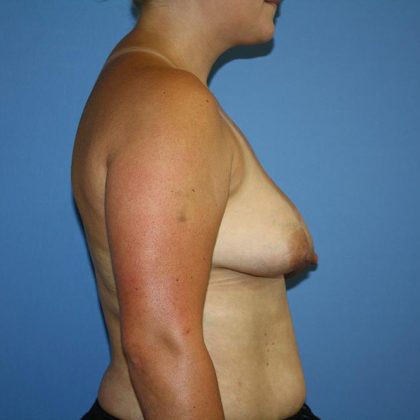 Breast Reconstruction Before & After Patient #5694